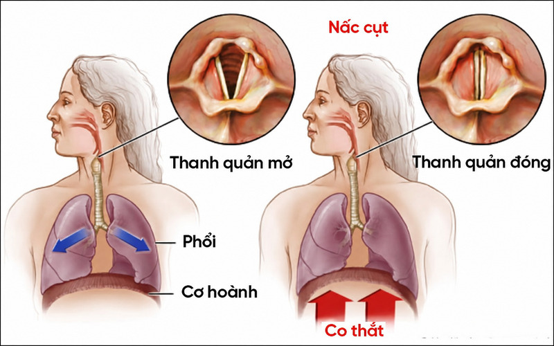 Nấc cụt xảy ra khi cơ hoành co thắt đột ngột, khiến dây thanh âm đóng nhanh và tạo tiếng “hic”. 
